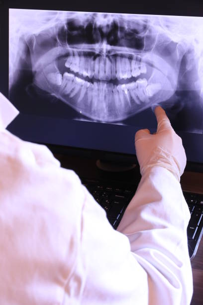 Best Emergency Wisdom Teeth Removal in Larkspur, CA